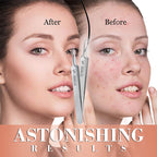 📢📢 50 %  OFF !! ⏰Blackhead Removal Tweezers for Beauty Salons