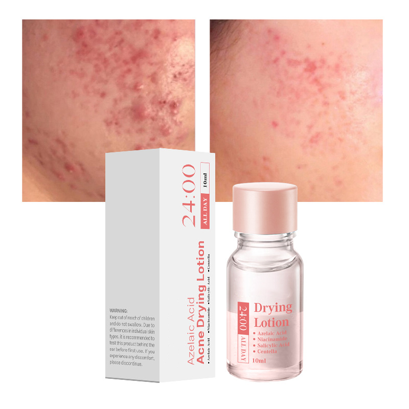 Today Only🎉Buy 1 Get 1 Free💆‍♀️Salicylic Acid Acne-Fighting Essence Toner