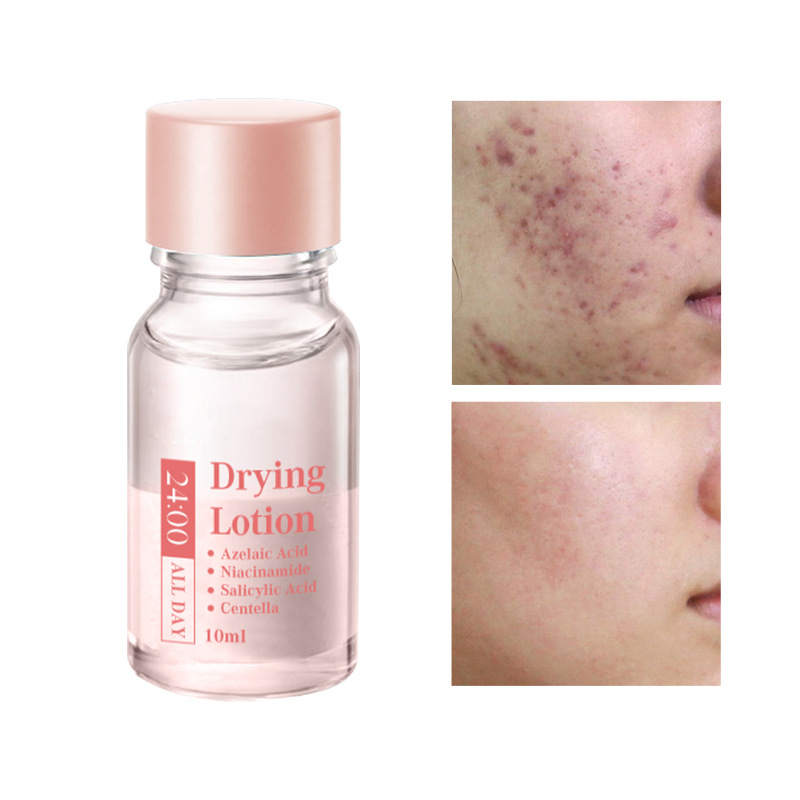 Today Only🎉Buy 1 Get 1 Free💆‍♀️Salicylic Acid Acne-Fighting Essence Toner